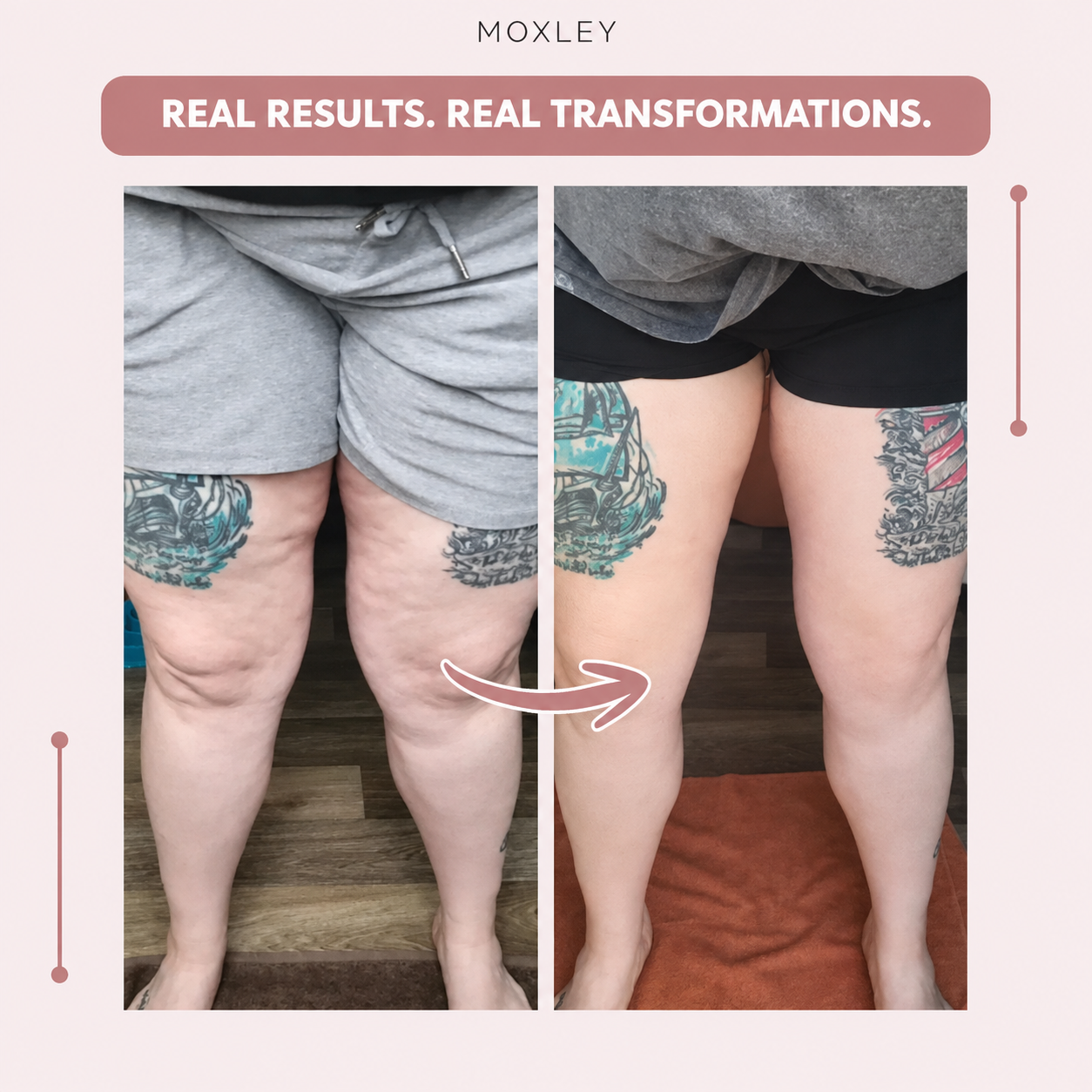 Moxley™ 3D Leggings – Naturally Say Goodbye to the Pain and Swelling of Lipoedema