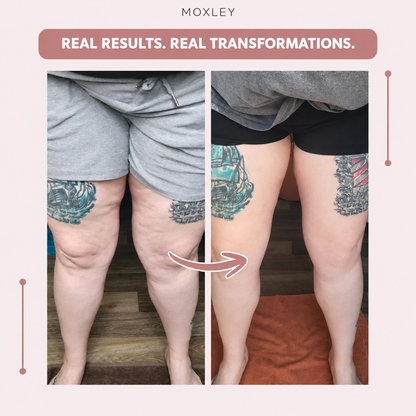 Moxley™ 3D Leggings – Naturally Say Goodbye to the Pain and Swelling of Lipoedema