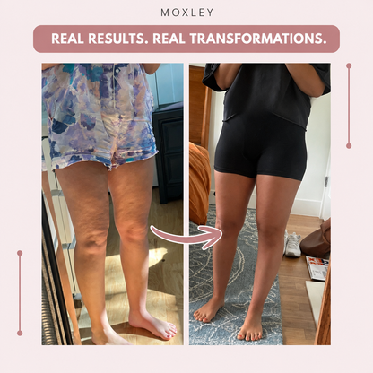 Moxley™ 3D Leggings – Naturally Say Goodbye to the Pain and Swelling of Lipoedema
