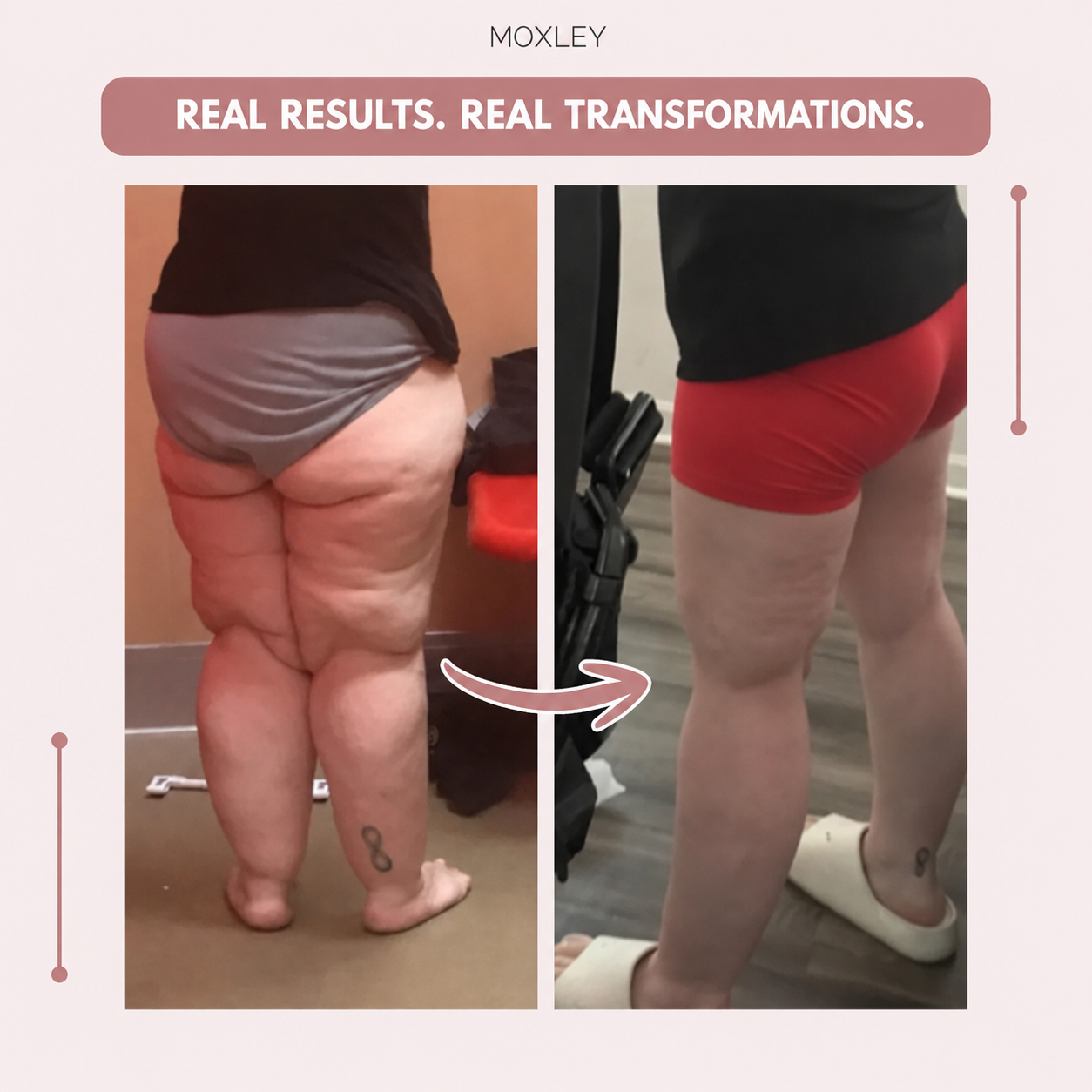 Moxley™ 3D Leggings – Naturally Say Goodbye to the Pain and Swelling of Lipoedema