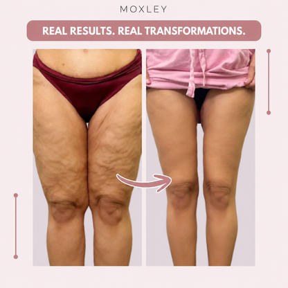 Moxley™ 3D Leggings – Naturally Say Goodbye to the Pain and Swelling of Lipoedema